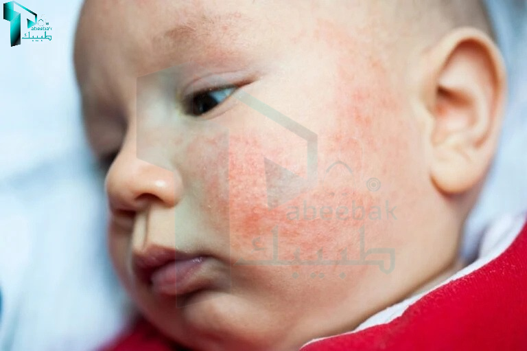 اكزيما الرضع